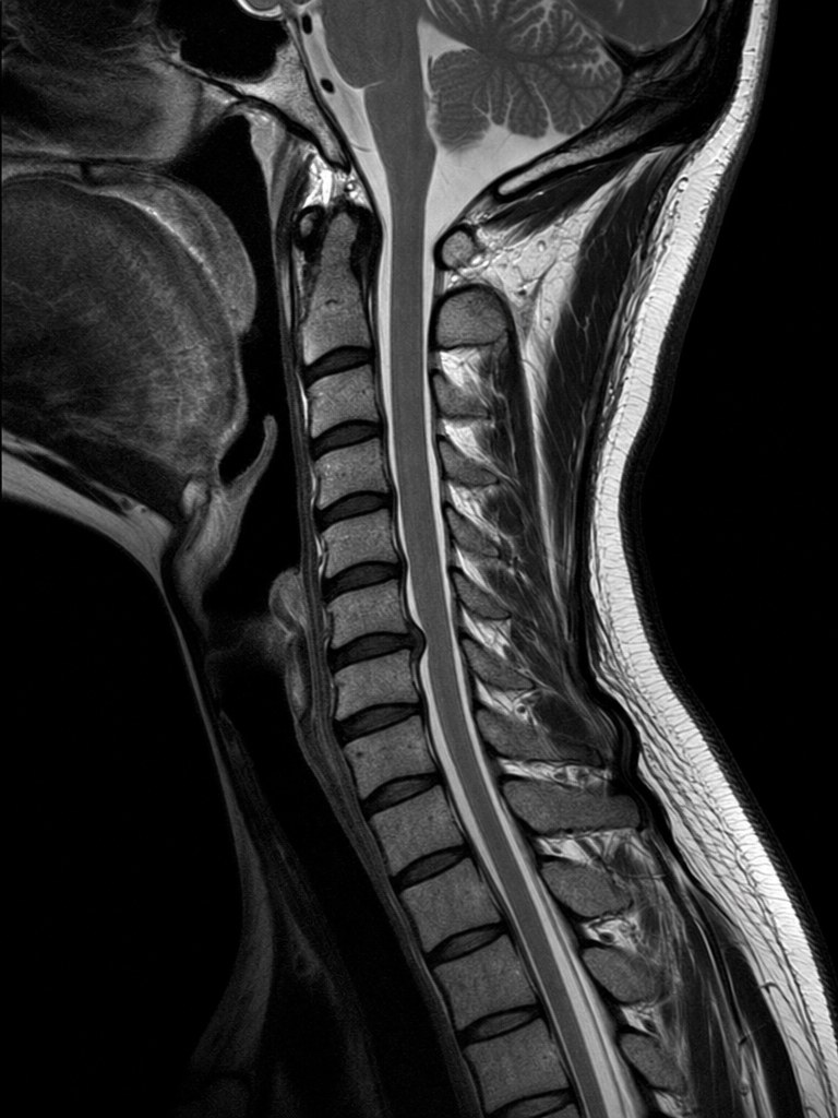 MRI kręgosłupa szyjnego - obraz poglądowy
