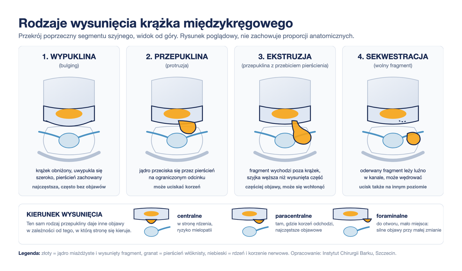 Schemat czterech rodzajów wysunięcia krążka międzykręgowego: wypuklina, przepuklina, ekstruzja, sekwestracja, oraz trzy kierunki wysunięcia